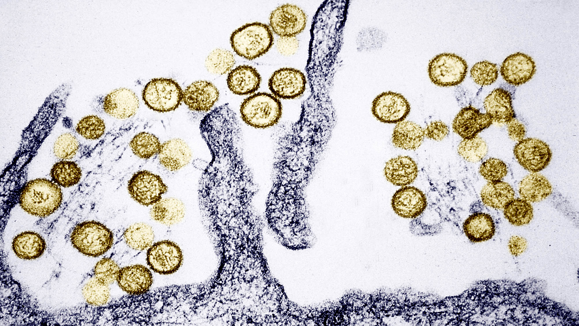 What To Know About Hantavirus