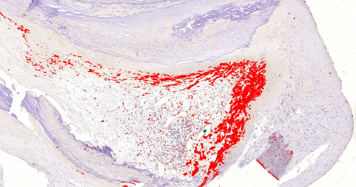 Myocardial infarction may be an infectious disease | Tampere universities