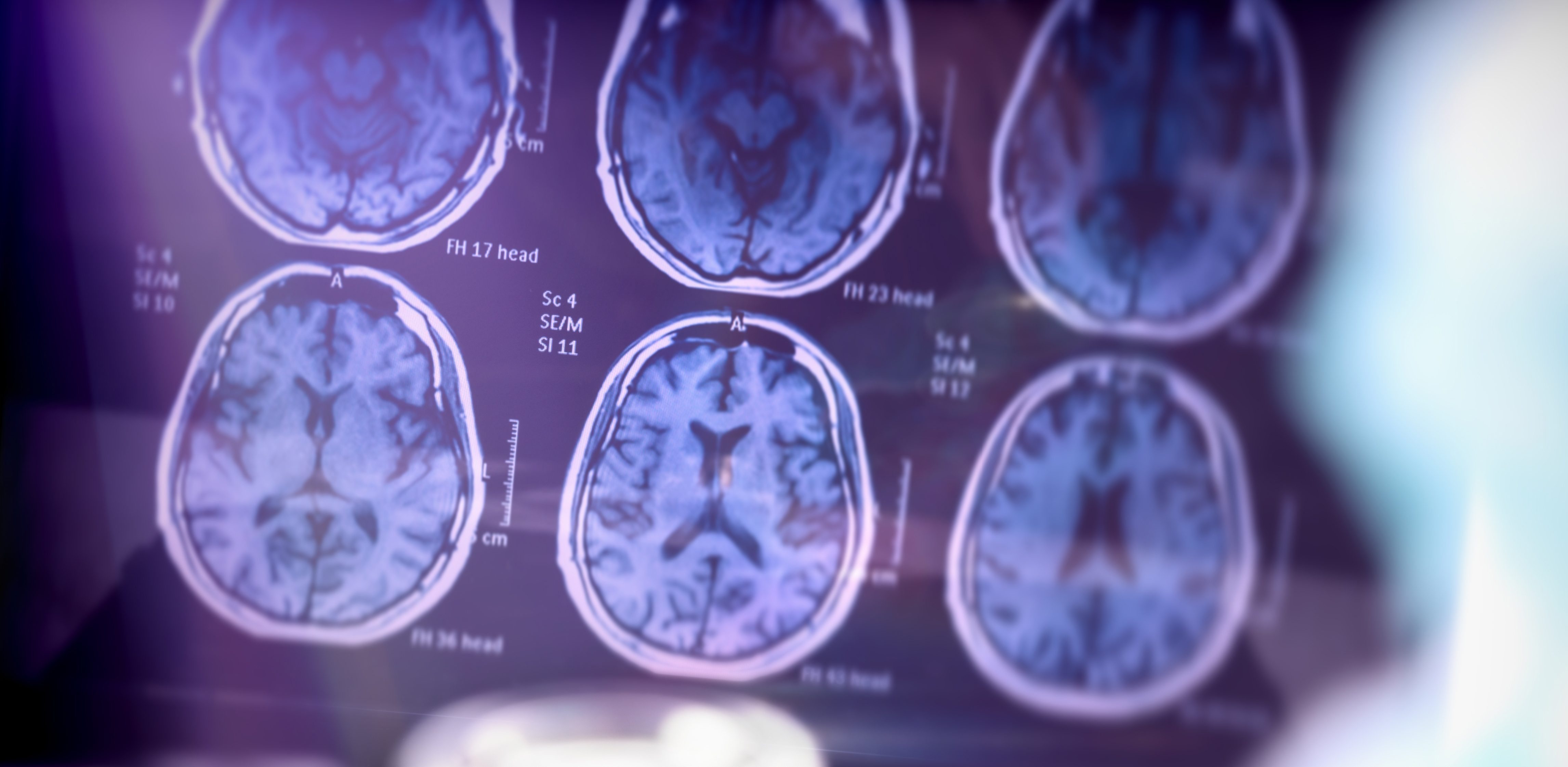 New nanotherapy clears amyloid-β reversing Alzheimer’s in mice