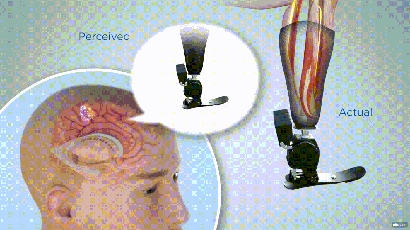Project Overview ‹ Agonist-antagonist Myoneural Interface (AMI) – MIT Media Lab